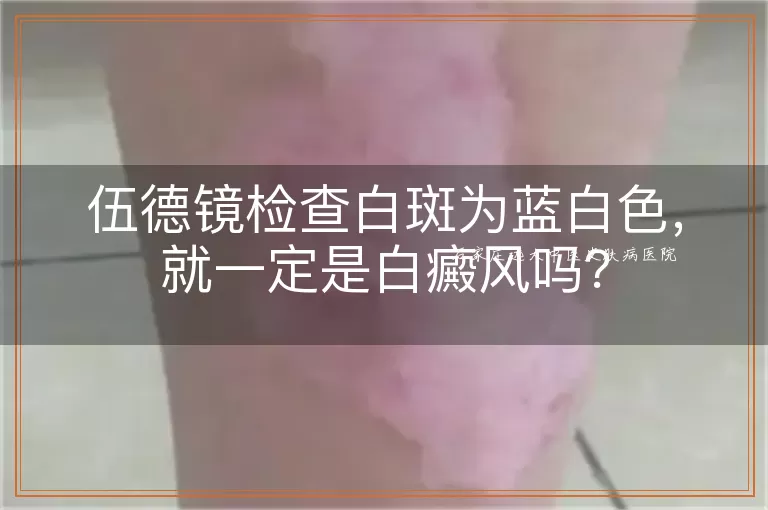 伍德镜检查白斑为蓝白色，就一定是白癜风吗？