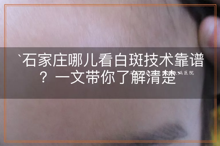石家庄哪儿看白斑技术靠谱？一文带你了解清楚