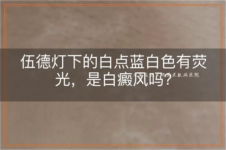 伍德灯下的白点蓝白色有荧光，是白癜风吗？