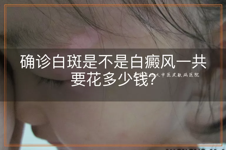 确诊白斑是不是白癜风一共要花多少钱？