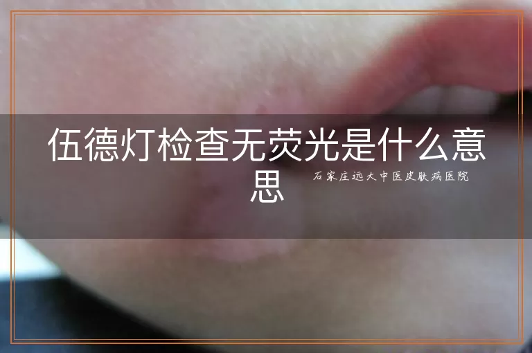 伍德灯检查无荧光是什么意思