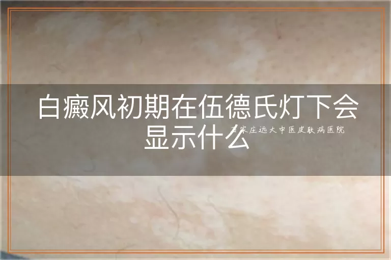 白癜风初期在伍德氏灯下会显示什么