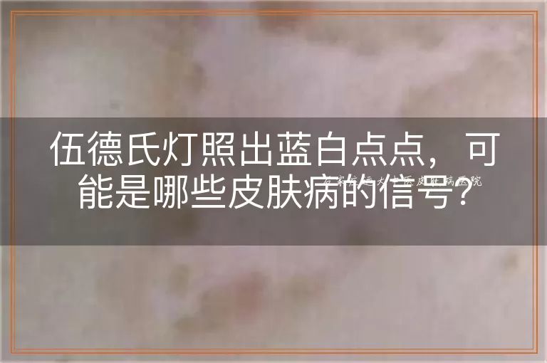 伍德氏灯照出蓝白点点，可能是哪些皮肤病的信号？