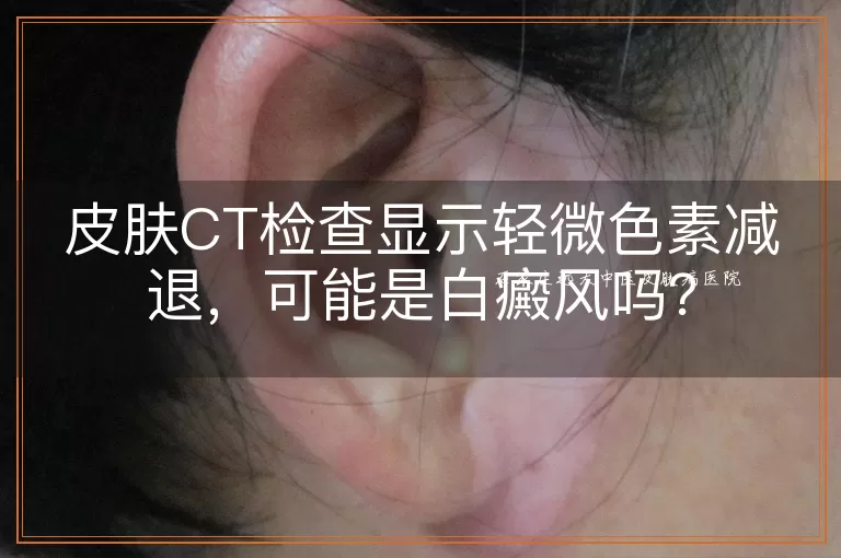 皮肤CT检查显示轻微色素减退，可能是白癜风吗？