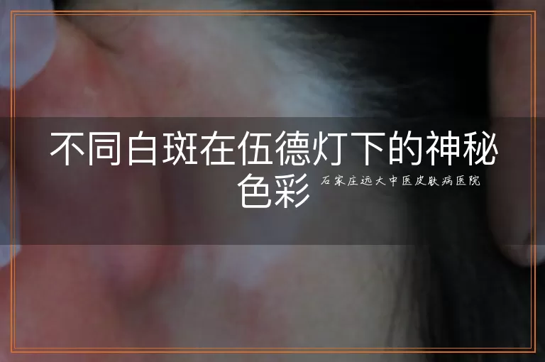 不同白斑在伍德灯下的神秘色彩