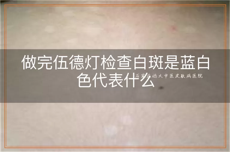 做完伍德灯检查白斑是蓝白色代表什么