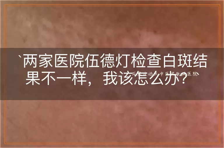 两家医院伍德灯检查白斑结果不一样，我该怎么办？