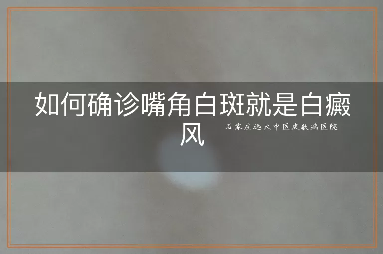如何确诊嘴角白斑就是白癜风