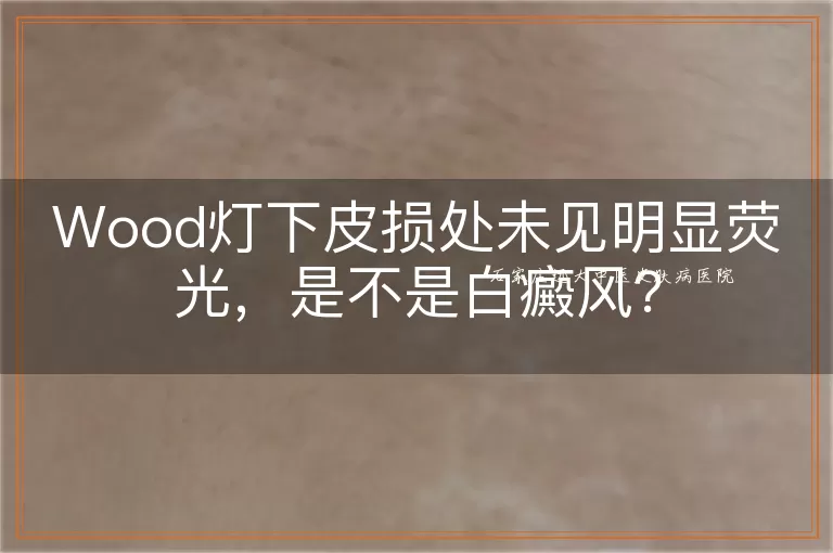 Wood灯下皮损处未见明显荧光，是不是白癜风？