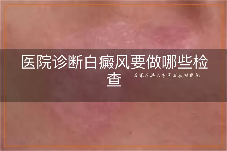 医院诊断白癜风要做哪些检查