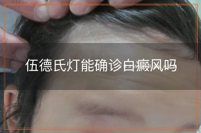 伍德氏灯能确诊白癜风吗