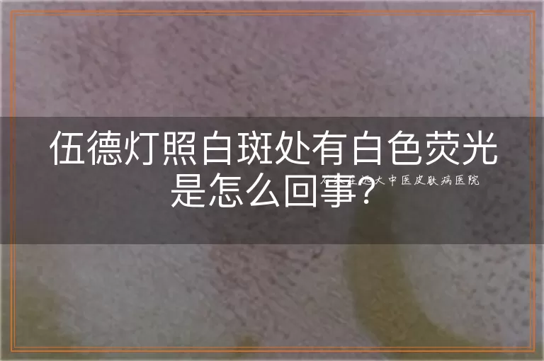 伍德灯照白斑处有白色荧光是怎么回事？