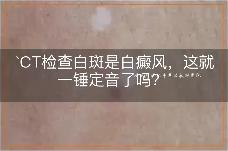 CT检查白斑是白癜风，这就一锤定音了吗？