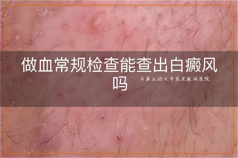 做血常规检查能查出白癜风吗