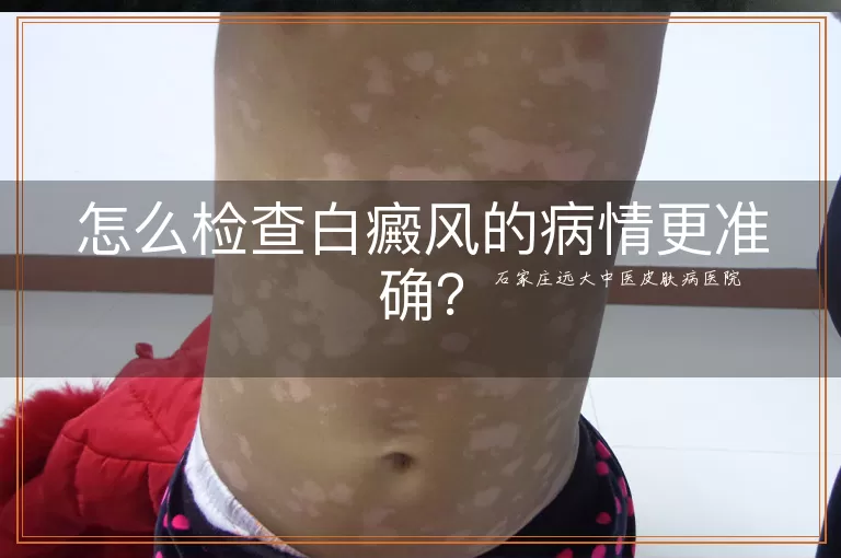 怎么检查白癜风的病情更准确？