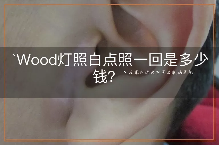 Wood灯照白点照一回是多少钱？