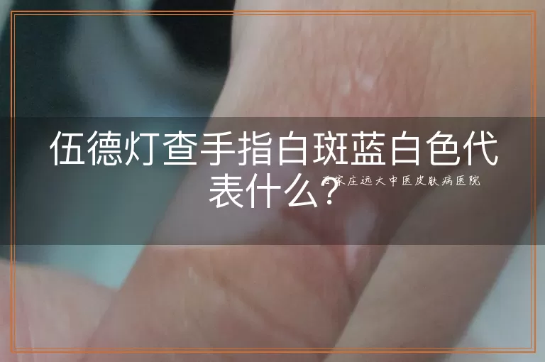 伍德灯查手指白斑蓝白色代表什么？