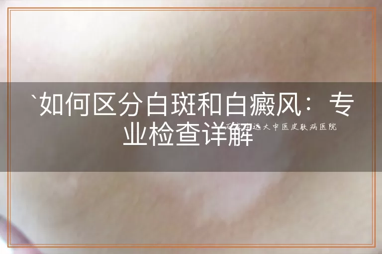 如何区分白斑和白癜风：专业检查详解