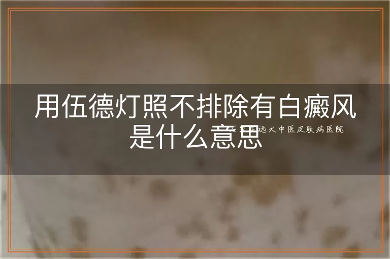 用伍德灯照不排除有白癜风是什么意思