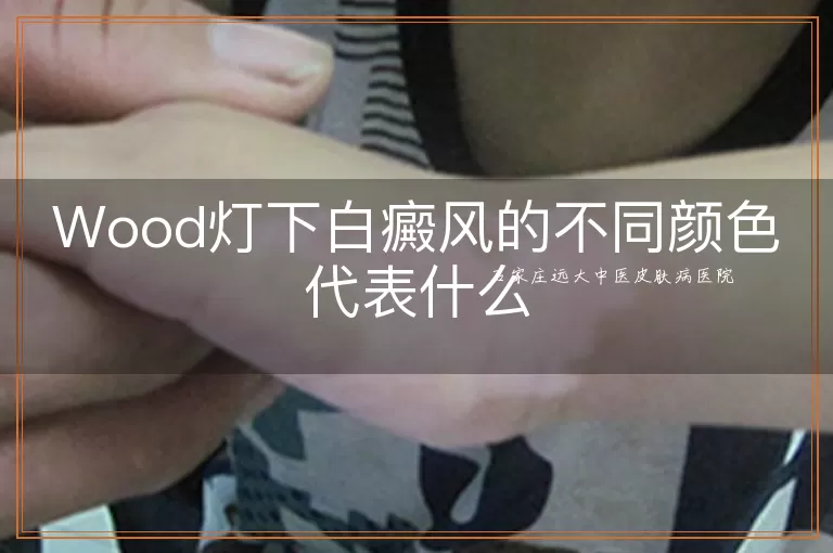 Wood灯下白癜风的不同颜色代表什么