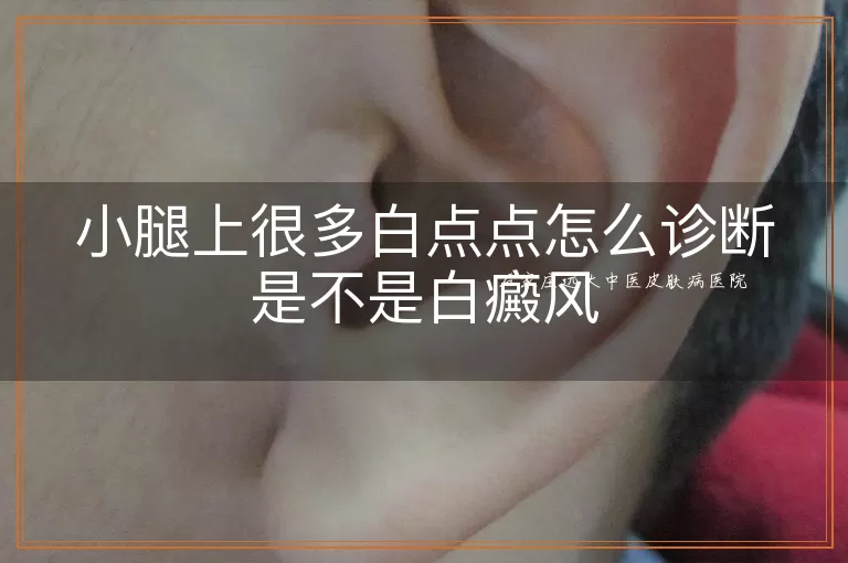 小腿上很多白点点怎么诊断是不是白癜风