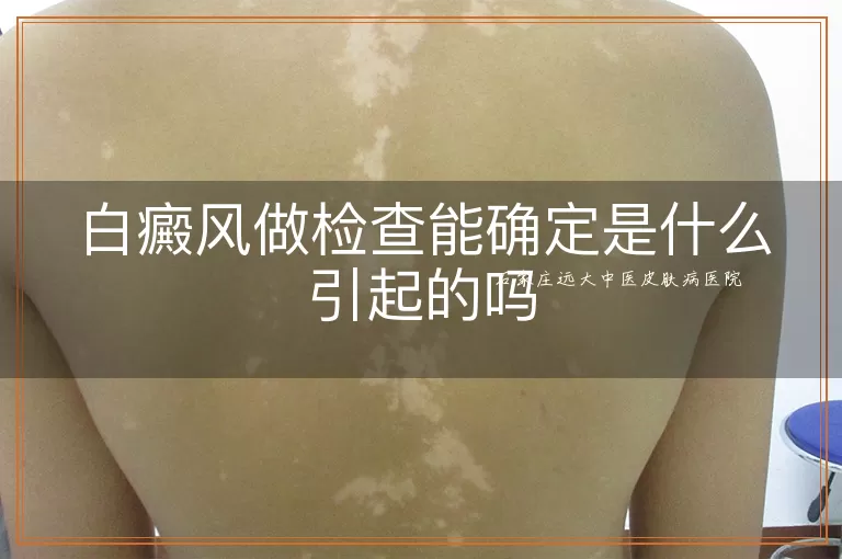 白癜风做检查能确定是什么引起的吗
