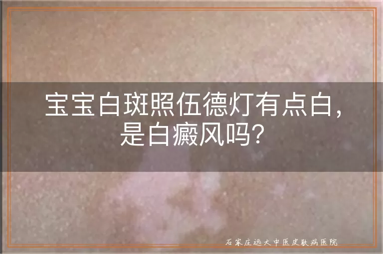 宝宝白斑照伍德灯有点白，是白癜风吗？
