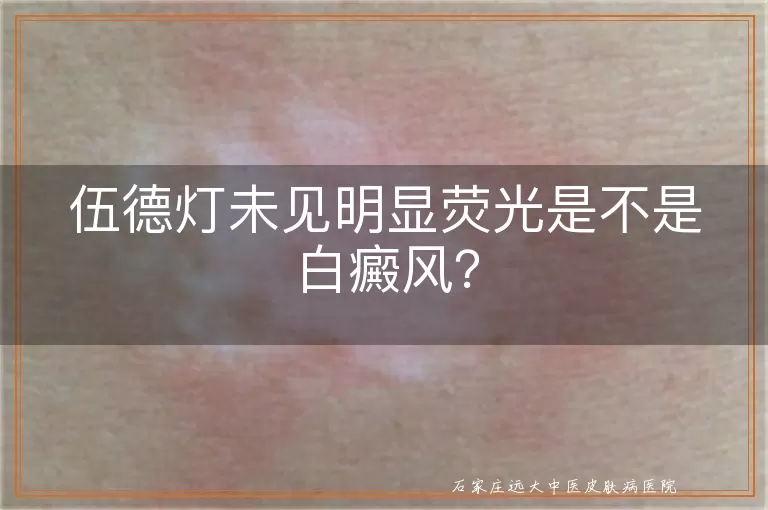 伍德灯未见明显荧光是不是白癜风？