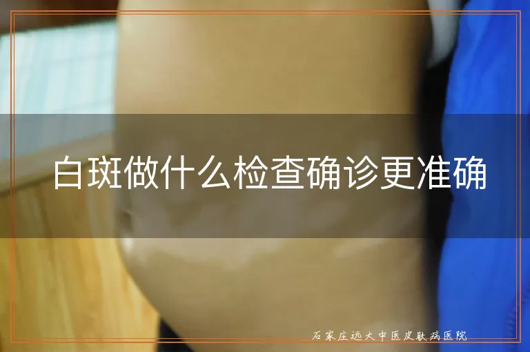 白斑做什么检查确诊更准确