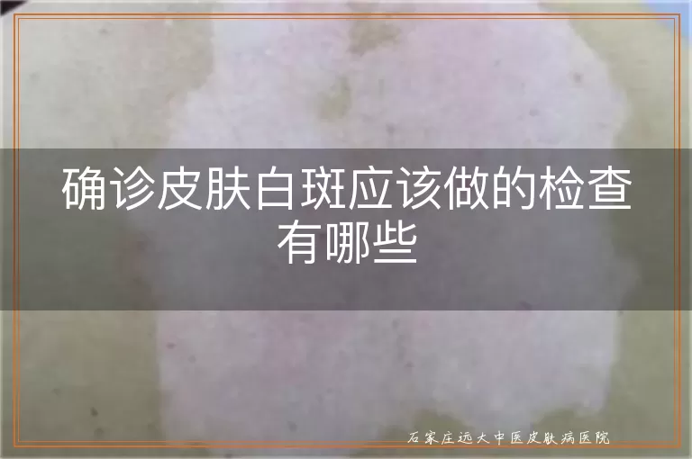 确诊皮肤白斑应该做的检查有哪些