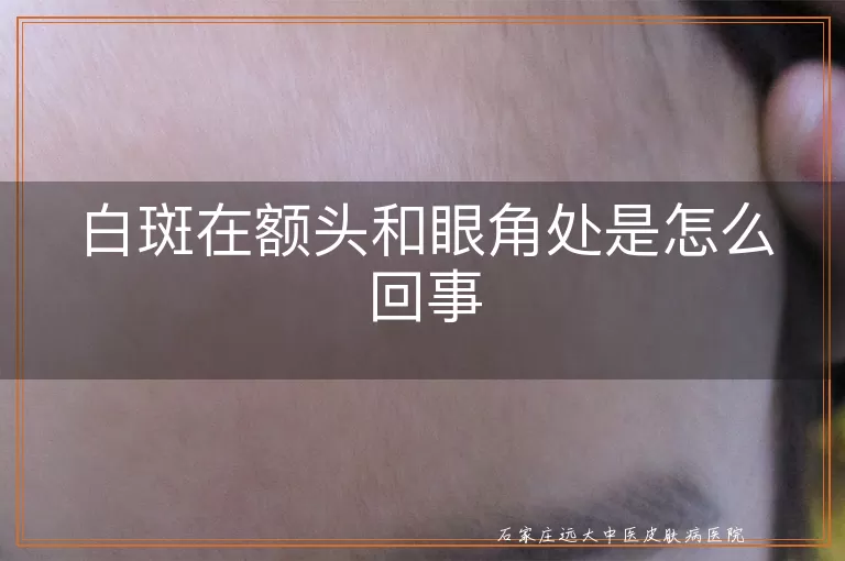 白斑在额头和眼角处是怎么回事