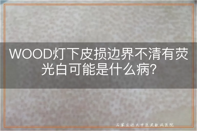 WOOD灯下皮损边界不清有荧光白可能是什么病？