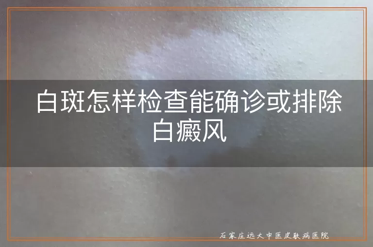 白斑怎样检查能确诊或排除白癜风
