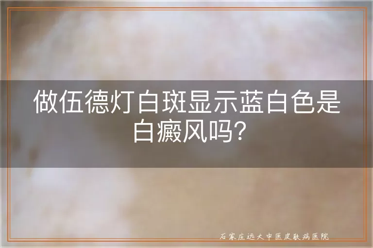 做伍德灯白斑显示蓝白色是白癜风吗？