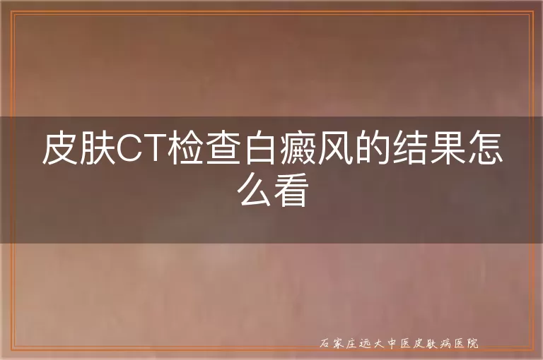 皮肤CT检查白癜风的结果怎么看