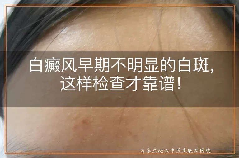 白癜风早期不明显的白斑，这样检查才靠谱！