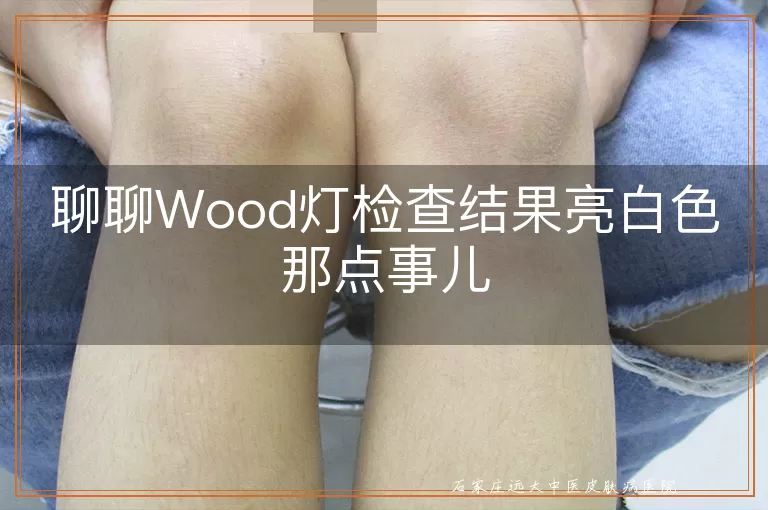 聊聊Wood灯检查结果亮白色那点事儿