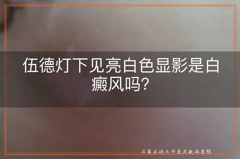 伍德灯下见亮白色显影是白癜风吗？