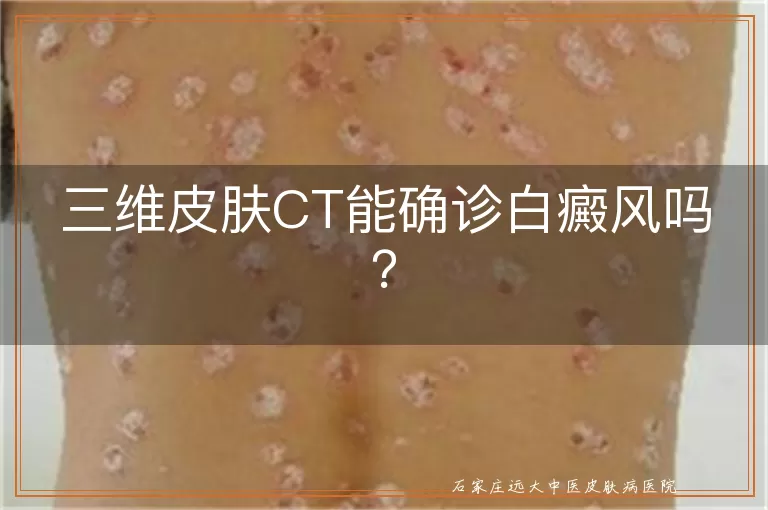 三维皮肤CT能确诊白癜风吗？