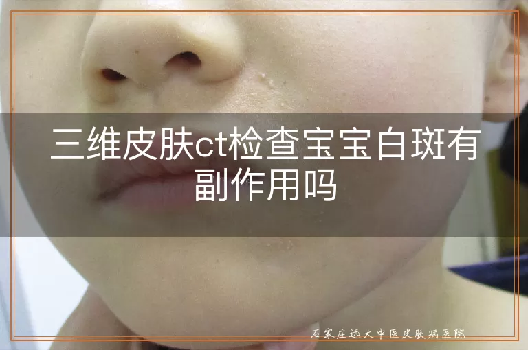 三维皮肤ct检查宝宝白斑有副作用吗