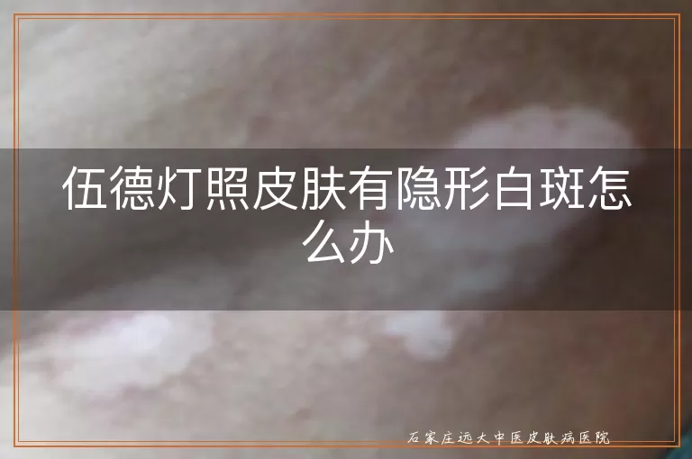 伍德灯照皮肤有隐形白斑怎么办