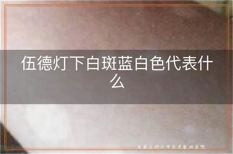 伍德灯下白斑蓝白色代表什么