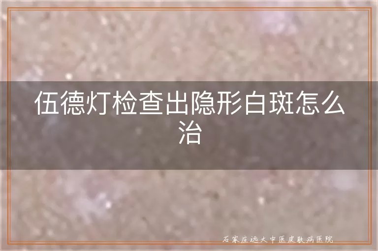 伍德灯检查出隐形白斑怎么治