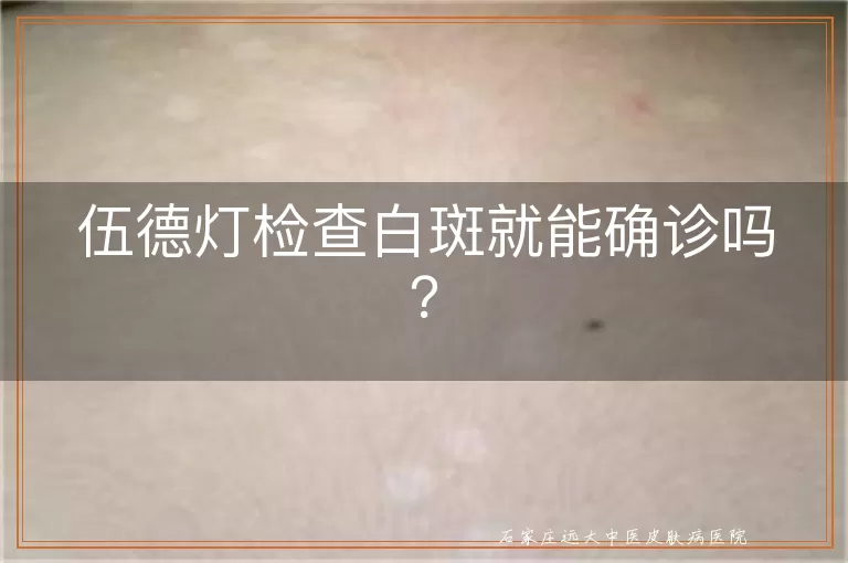 伍德灯检查白斑就能确诊吗？