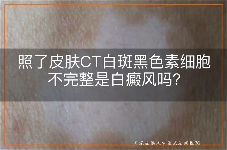 照了皮肤CT白斑黑色素细胞不完整是白癜风吗？