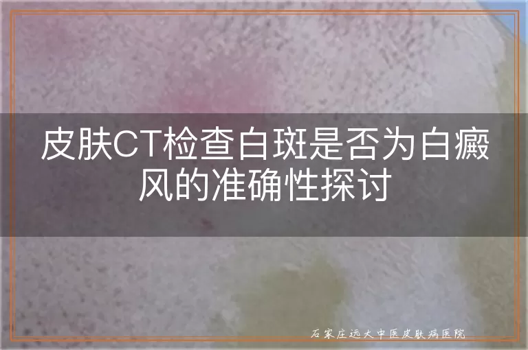 皮肤CT检查白斑是否为白癜风的准确性探讨