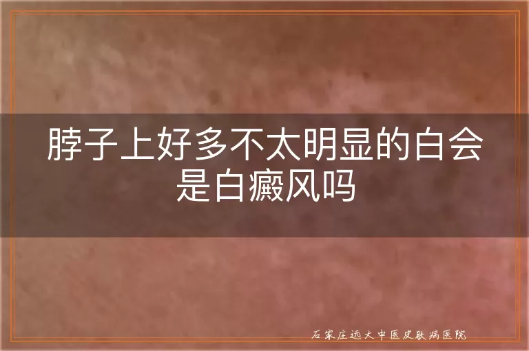 脖子上好多不太明显的白会是白癜风吗