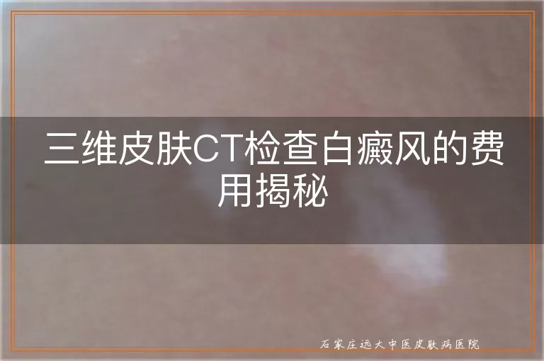 三维皮肤CT检查白癜风的费用揭秘