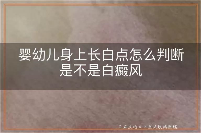 婴幼儿身上长白点怎么判断是不是白癜风