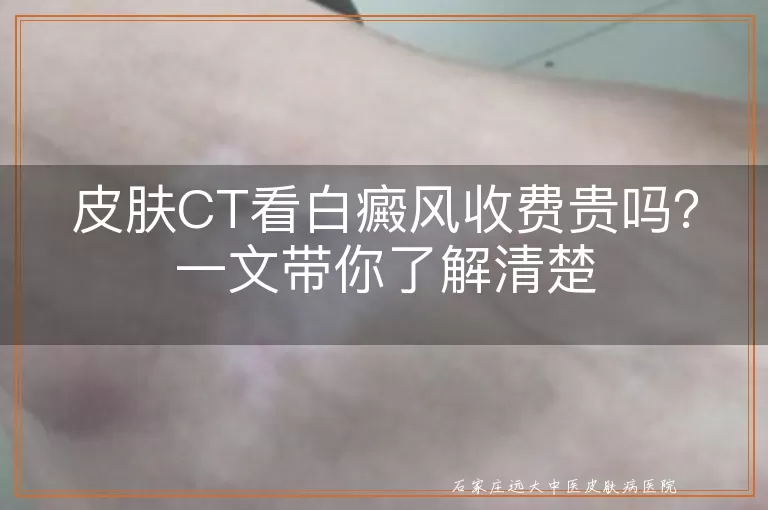 皮肤CT看白癜风收费贵吗？一文带你了解清楚